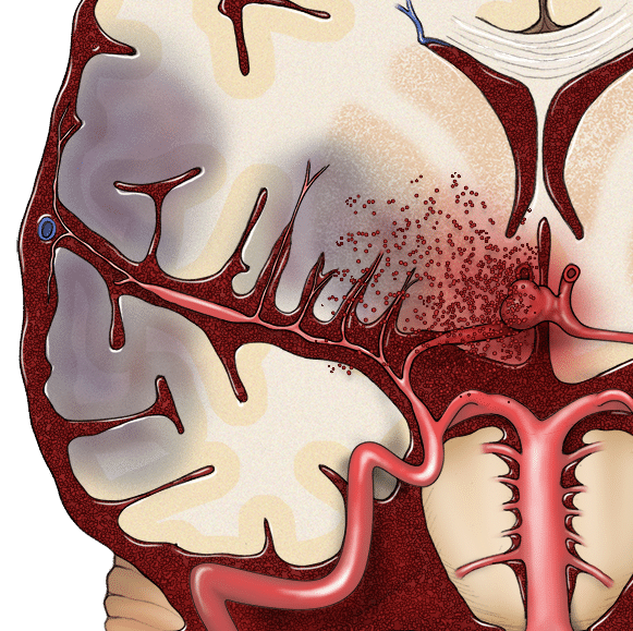 Medical Illustration: Brain Aneurysm